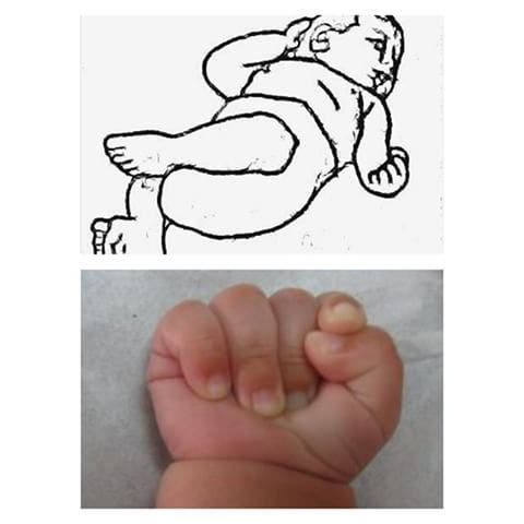 Es muscular que una hipertonia